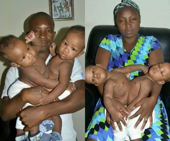 Woman Gives Birth To Conjoined Twins In Lagos