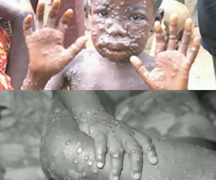 Monkey Pox In Lagos