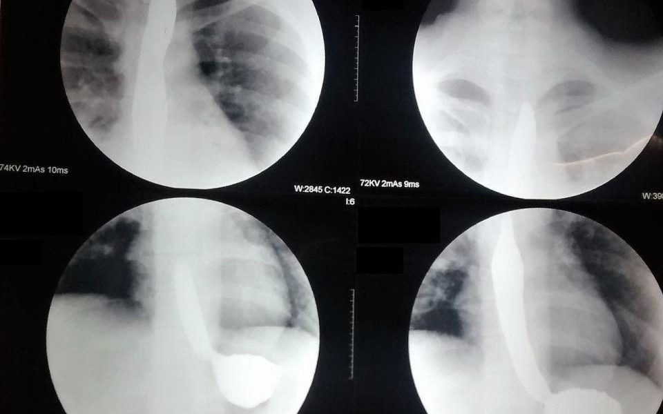Doctors Discover 9 Nails In Woman’s Stomach
