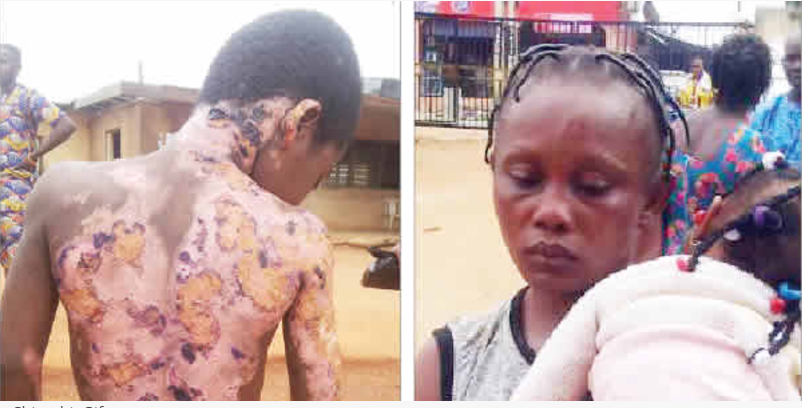 [PHOTO] 10-Year-Old Boy Set Ablaze By Brother’s Nursing Wife In Ikorodu