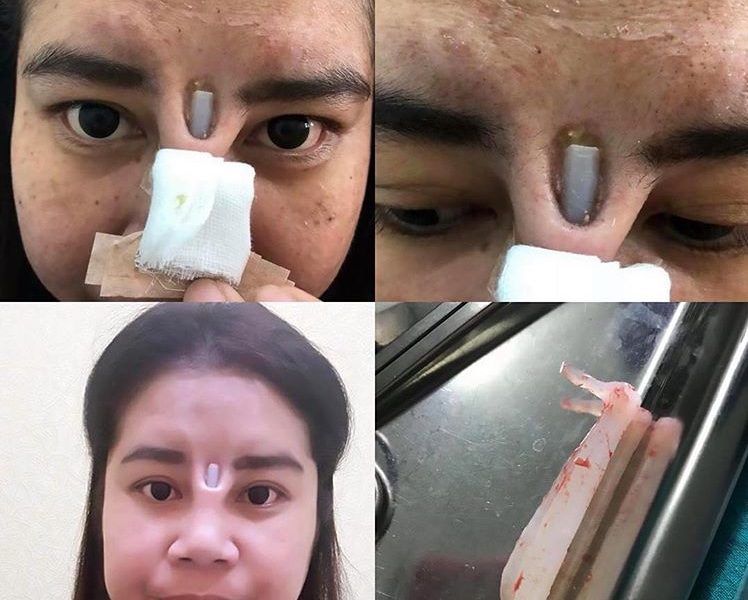 Woman’s Botched Nose Job Leaves Her With Implant Poking Through Her Skin