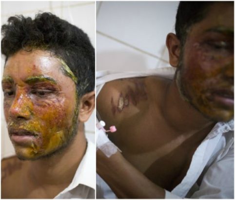 16-Yr-Old Girl Bathes Boy With Acid For Rejecting Her Love Proposal