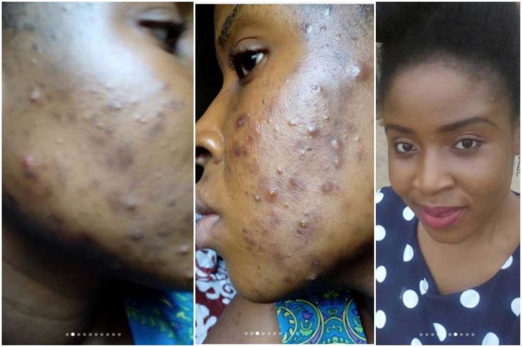 Nigerian gospel singer Sharon Ajao (Sharonee) has shared Before and After photos of what she calls a testimony, miraculous healing from acne after her pastor commanded the acne to dry up and never come back again. Nigerian singer 'healed' of acne after pastor commanded it to dry up lailasnews Share According to singer Sharon, her pastor is Dr Paul Enenche, the founder and senior pastor of the Dunamis International Gospel Centre headquartered in Abuja. Sharon says he had commanded her acne to dry up and one year later, the acne has never been back. Read her story below and tell us what you think. Photos Sharon shared are below: Nigerian singer 'healed' of acne after pastor commanded it to dry up lailasnews 2 Share Who says miracles aren’t real? who says they are temporal? April is about to end and I haven’t forgotten that it was April 13th last year that my father Dr Paul Enenche cursed the terrible acne on my face, that defied all medical and natural remedies. He said “I command you to dry up!” and he told me sometime later after it had dried up (it dried up the next morning after that decree) “it will never come back” Its a year now and I am still free. I had to compile a lot of photos to shame the devil that wanted to make me ugly. Nigerian singer 'healed' of acne after pastor commanded it to dry up lailasnews 3 Share Nigerian singer 'healed' of acne after pastor commanded it to dry up lailasnews 4 Share It wasn’t coincidental that we sang today in the choir a song titled “thank you Lord” a song by Dr Paul Enenche. I sang that song from every fibre of my being because a lot crossed my mind while we sang. A lot happened from that 13th of April encounter that hasn’t left me the same. I am grateful to my healer and also thankful for the blessing of a spiritual cover. Whatever God does is permanent. Miracles are real and they are forever.