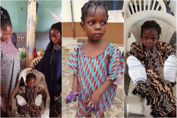 Little Girl Whose Hands Were Burnt By Grandmother Undergoes Surgery