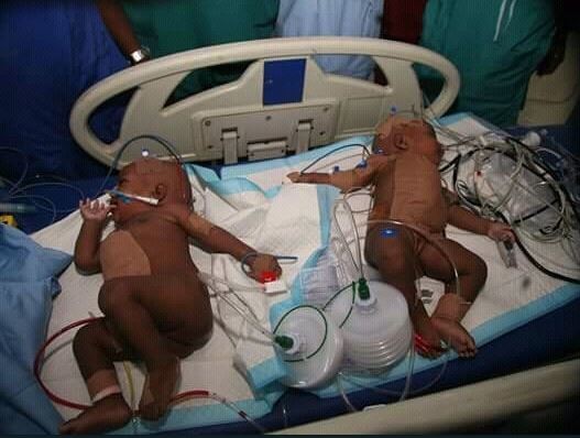 Photos: Federal Medical Center, Yola Successfully Separates Conjoined Female Twins