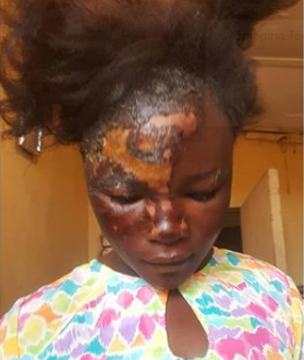 Lady Pours Hot Water On Maid For Stealing Eggs (photos)