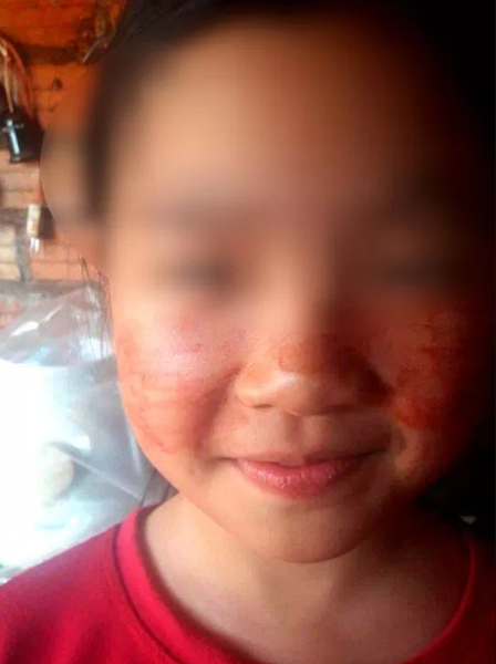 11-Year-Old Begins Sweating Blood As She Revised For Exams (Photos)