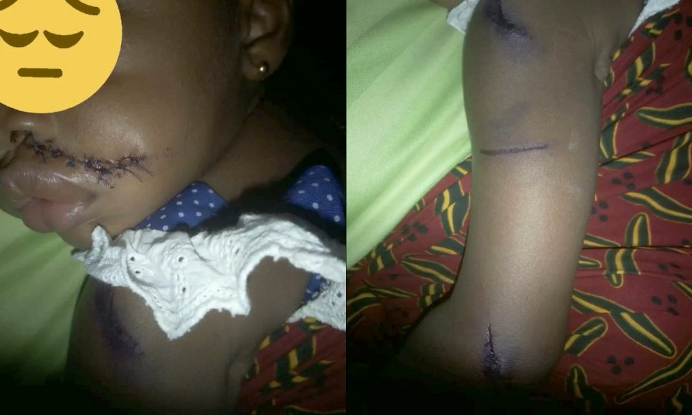 Man Shares Heartbreaking Photos Of Niece Who Returned From School With Unexplained Scars