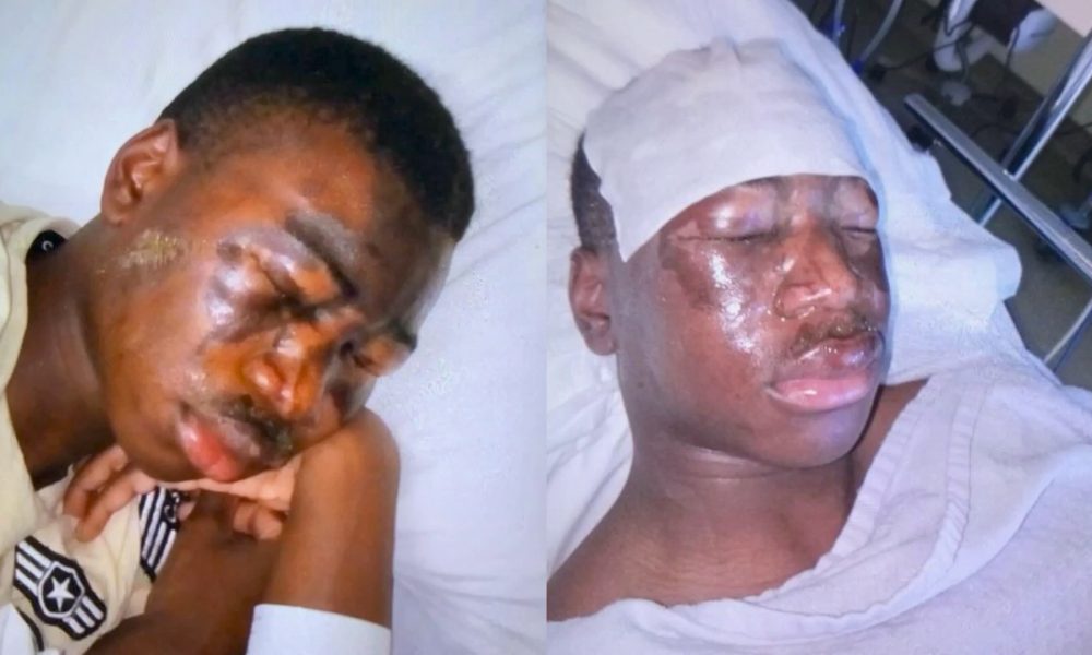 Young Nigerian Footballer In The UK Suffers Horrific Facial Injuries After ‘Acid Attack’