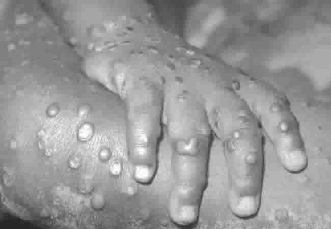 NCDC Reveals Spread of Monkeypox Disease In Nigeria